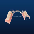 Detachable Denture Metal Partial Bridge